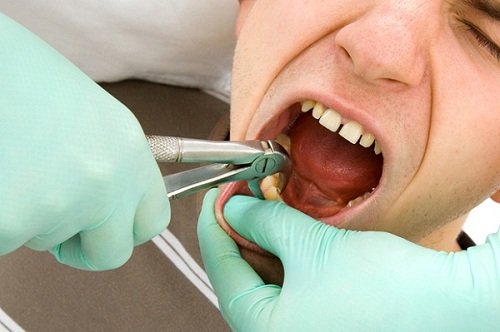Viêm lợi trùm răng khôn ảnh hưởng như thế nào đến răng? 2