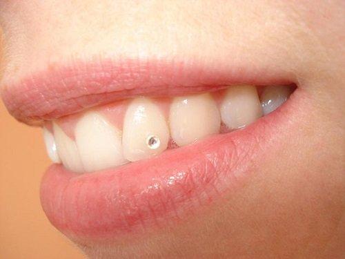 Thực hư việc đính đá vào răng có hại không? 2