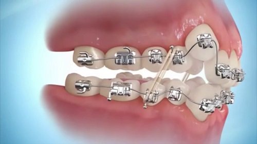 Niềng răng khểnh giúp giải quyết vấn đề gì về răng miệng 3