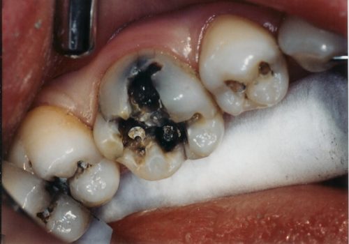 Răng bị sâu nặng có nên trồng răng sứ không? 2