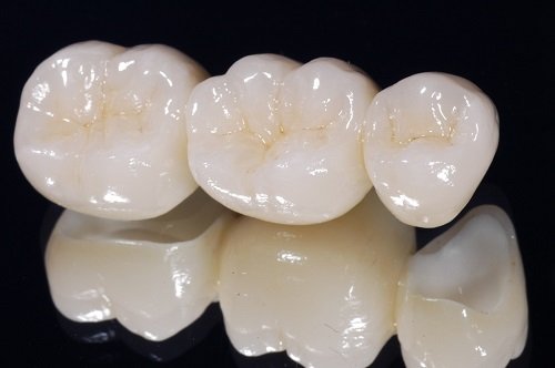 Trồng răng giả loại nào tốt và đảm bảo ăn nhai? 3
