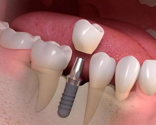 Phương pháp trồng răng giả mất bao lâu thời gian? 1