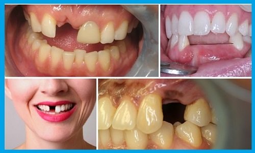 Phương pháp trồng răng giả mất bao lâu thời gian? 2