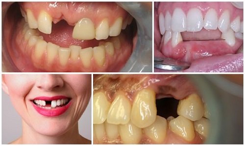 Trường hợp nào nên trồng răng sứ? Trồng răng sứ có tốt không? 1