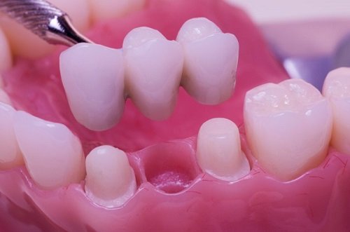 Trồng răng sứ mất bao lâu là hoàn thành quy trình?2