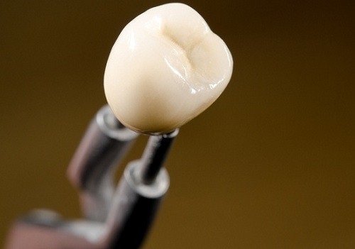 Bọc răng sứ bị cộm - Nguyên nhân và cách khắc phục 1