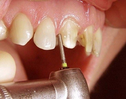 Bọc răng sứ bị cộm - Nguyên nhân và cách khắc phục 3
