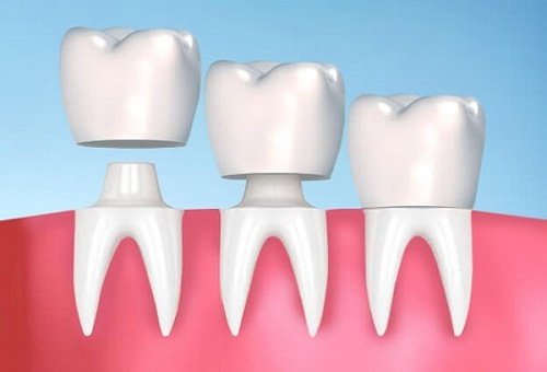 Ưu và nhược điểm của dịch vụ bọc răng sứ cercon 2