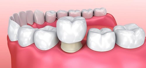 Bọc răng sứ chỉnh hô áp dụng hiệu quả không? 1