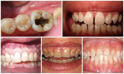 Bọc răng sứ chỉnh hô áp dụng hiệu quả không? 2