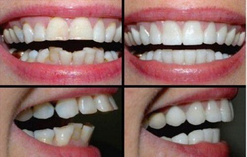 Bọc răng sứ chỉnh hô áp dụng hiệu quả không? 3