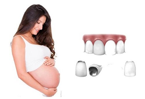 Bọc răng sứ khi mang thai - Cần lời khuyên từ nha khoa 3