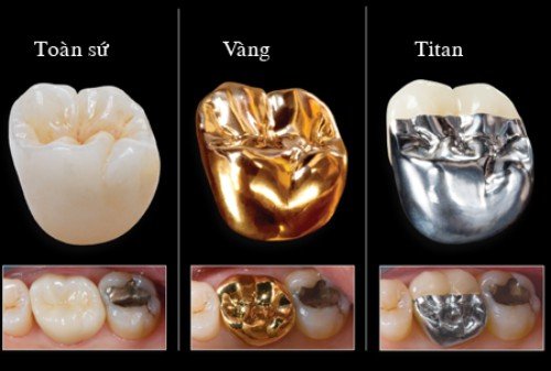 Bọc răng sứ titan có tốt không với răng sứt mẻ? 2