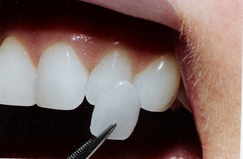 Các trường hợp nên áp dụng bọc răng sứ veneer 1