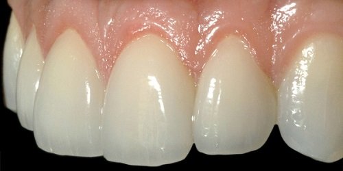 Bọc răng sứ zirconia - Ưu điểm và hạn chế 4