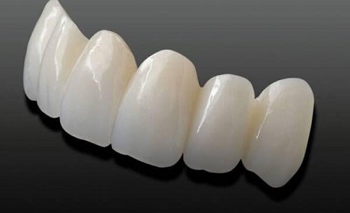 Bọc răng toàn sứ có những ưu điểm gì? 1