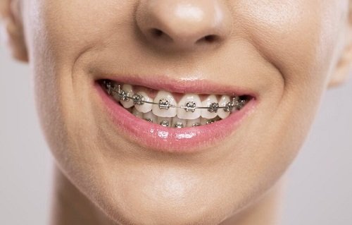 Niềng răng có nguy hiểm không cho người trưởng thành? 2