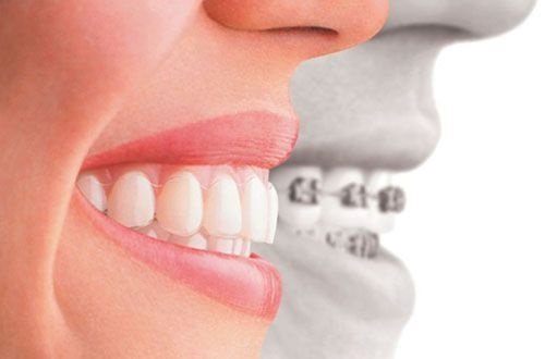 Niềng răng invisalign có tốt không? 3