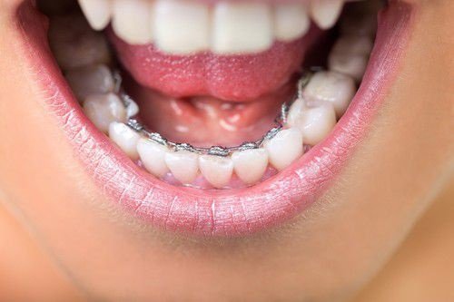 Niềng răng mắc cài mặt lưỡi là như thế nào? 1