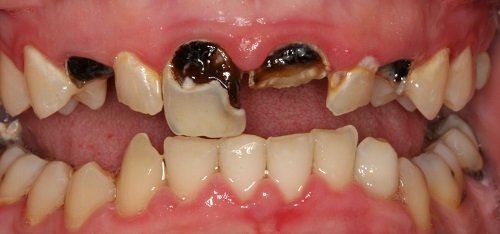 Quá trình trám răng cửa bị sâu được thực hiện như thế nào? 2