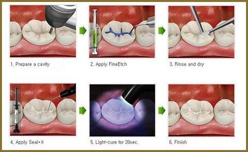 Quá trình trám răng cửa bị sâu được thực hiện như thế nào? 3