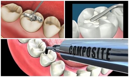 Quá trình trám răng cửa bị sâu được thực hiện như thế nào? 4