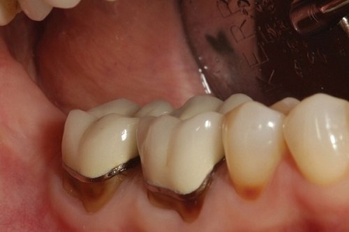 Bọc răng sứ bị hở có thể bọc lại để khắc phục không? 2