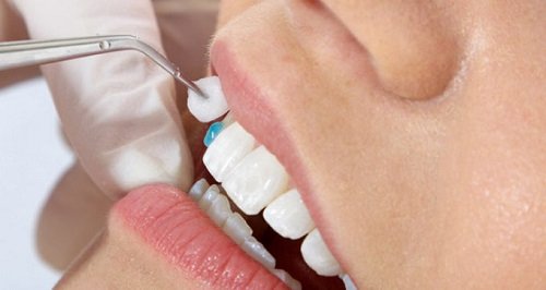 Bọc răng sứ bị hở có thể bọc lại để khắc phục không? 3