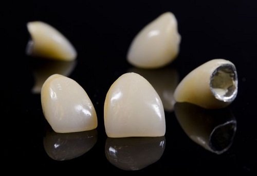Bọc răng sứ kim loại có bền không? Chăm sóc răng đúng cách 1