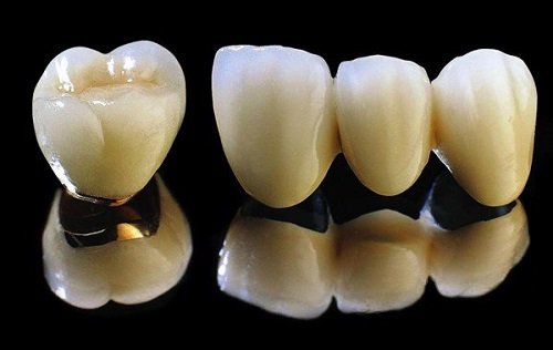 Bọc răng sứ kim loại có tốt không khi áp dụng cho răng cửa? 1