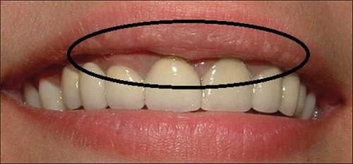 Bọc răng sứ kim loại có tốt không khi áp dụng cho răng cửa? 3