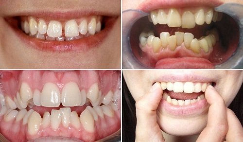 Niềng răng có làm răng yếu đi hay tổn hại men răng không? 1