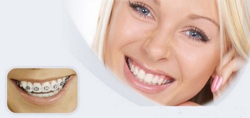 Niềng răng có làm răng yếu đi hay tổn hại men răng không? 2