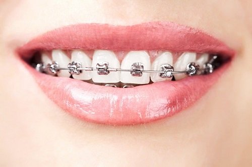 Niềng răng mắc cài kim loại tự buộc là gì? Có tốt không? 1