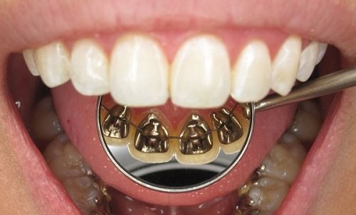 Niềng răng mặt trong mất bao lâu là có răng đẹp? 3