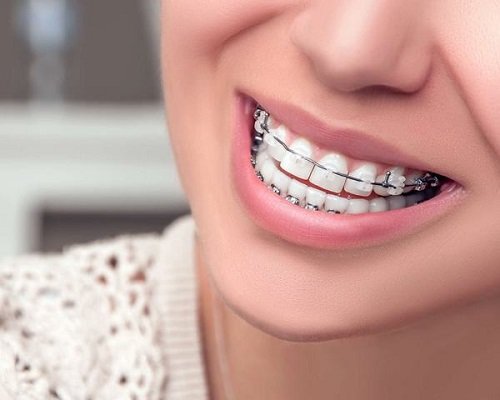 Niềng răng móm mất bao lâu? Cách nào rút ngắn thời gian 2
