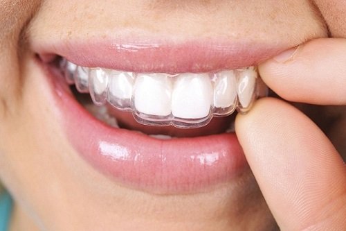 Niềng răng trong suốt mất bao lâu là răng đẹp? 1
