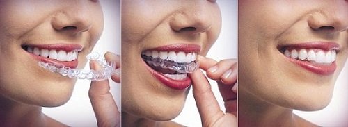 Niềng răng trong suốt mất bao lâu là răng đẹp? 2
