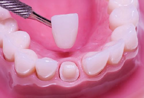 Bọc răng chữa móm không phẫu thuật nhanh chóng tiết kiệm 1