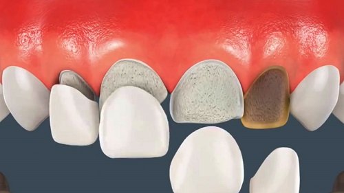 Bọc răng sứ veneer có tốt không khi bị nhiễm màu răng? 1