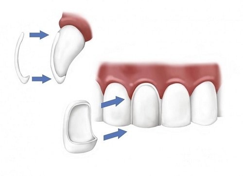 Bọc răng sứ veneer có tốt không khi bị nhiễm màu răng? 2