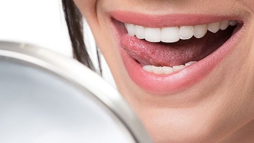 Bọc răng sứ veneer có tốt không khi bị nhiễm màu răng? 3