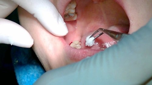 Nhổ răng hàm có ảnh hưởng gì không? Về vấn đề sức khỏe 1