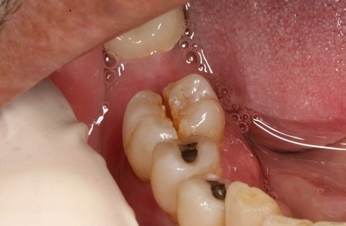 Nhổ răng hàm có ảnh hưởng gì không? Về vấn đề sức khỏe 2