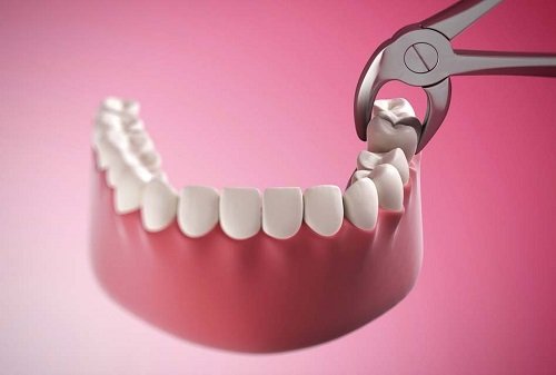 Nhổ răng hàm có ảnh hưởng gì không? Về vấn đề sức khỏe 3
