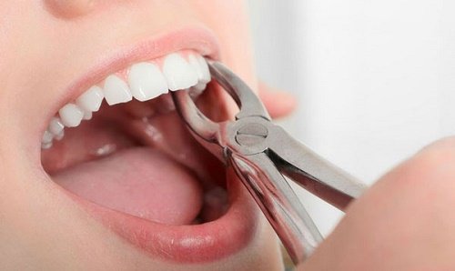 Răng khôn bị mọc kẹt nhổ răng khôn có tốt không? 2