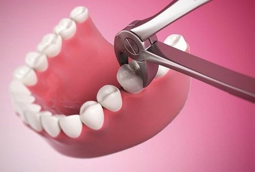 Nhổ răng khôn hàm dưới có nguy hiểm không? Vì sao  1