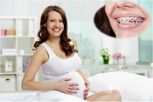 Niềng răng khi mang thai những điều bạn cần lưu ý 2