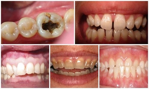 Các trường hợp làm răng sứ cả hàm hiệu quả 2