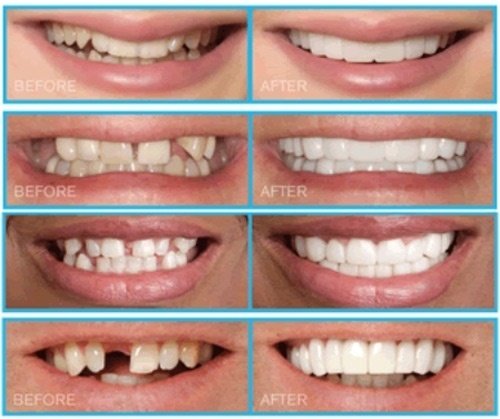 Các hình thức làm răng sứ cercon phổ biến 1